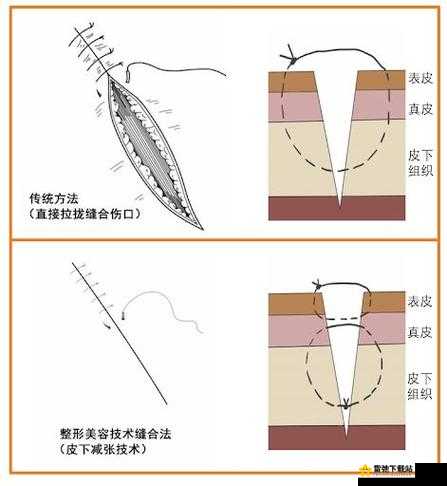 竹板打肿臂缝合不上，急寻医疗妙手神针